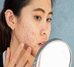 Acne - also called pimples