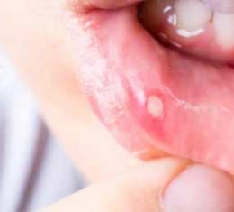 Aphthae - mouth ulcer