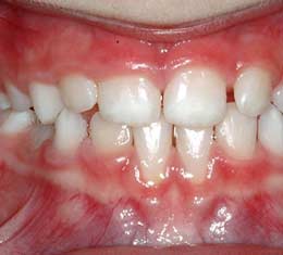 Dentition - Development of teeth